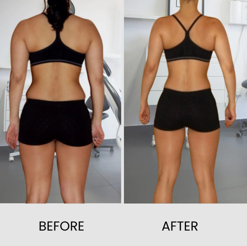 EMShape Neo+ Before & After 2