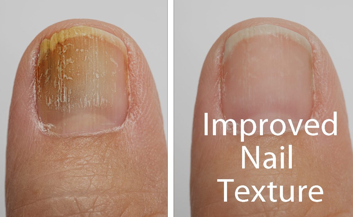 Toenail Fungus Laser Before & After 2