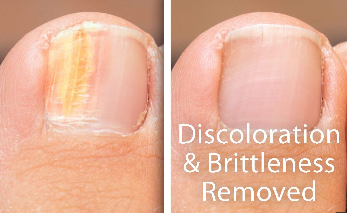 Toenail Fungus Laser Before & After 1