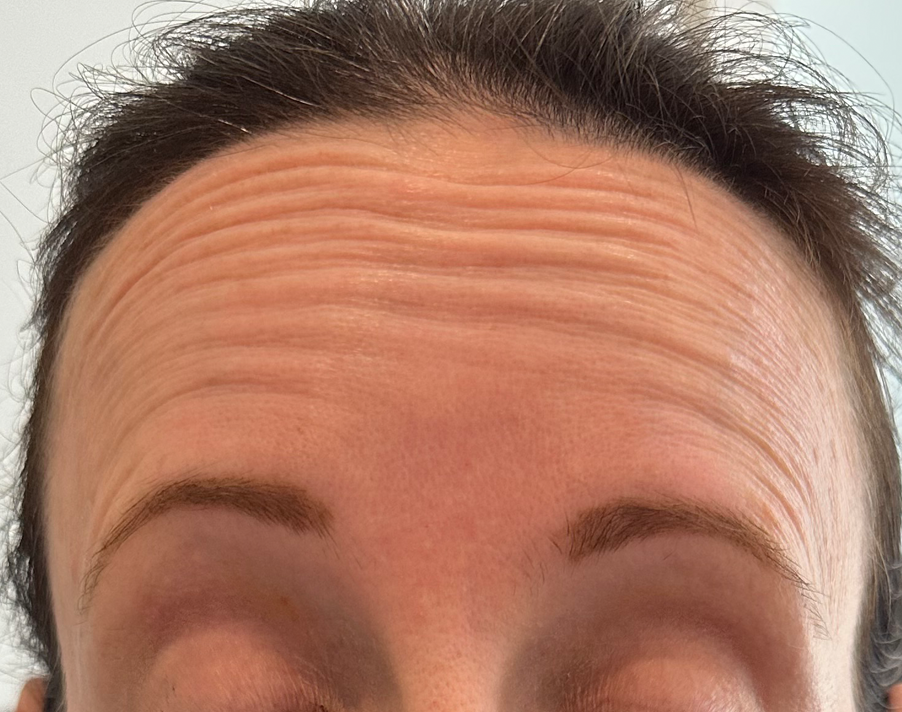Forehead Lines