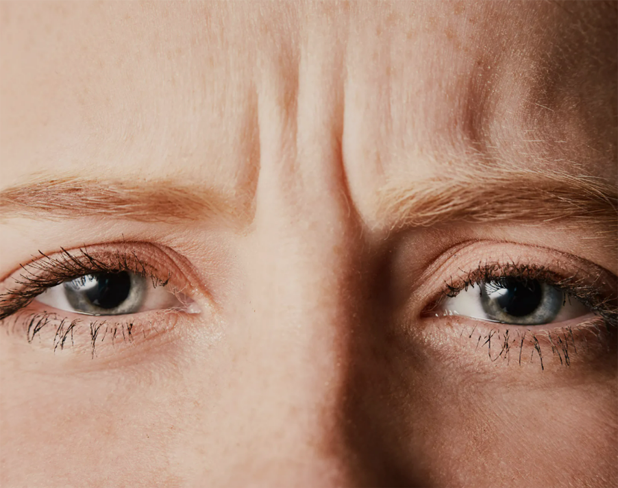 Frown Lines Glabella